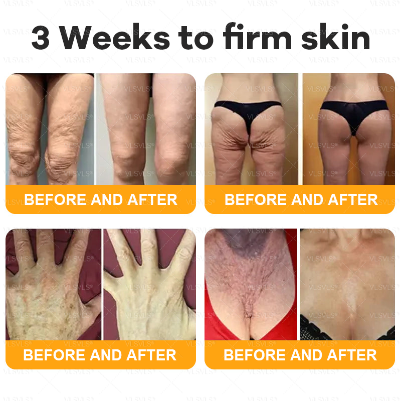 🌻VLSVLS® Bee Venom Comprehensive Cream  🇨🇦🇨🇦LAST DAY 80% OFF (Sagging Skin, Fine Lines, Loss of Firmness, Flat Bust, Drooping Hips, and More)
